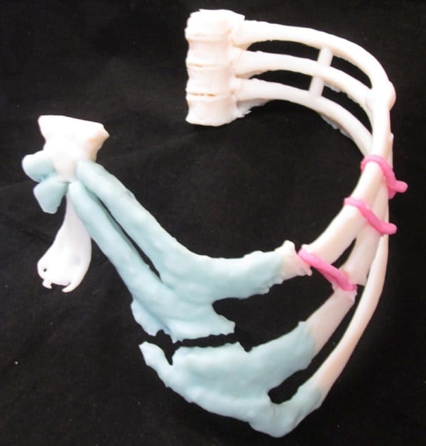 3D printing enhances chest wall reconstruction