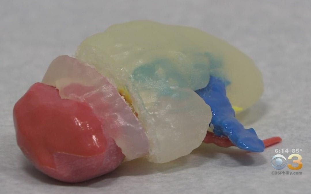 Doctors Use 3D Printer To Replace 5-Year-Old’s Kidney