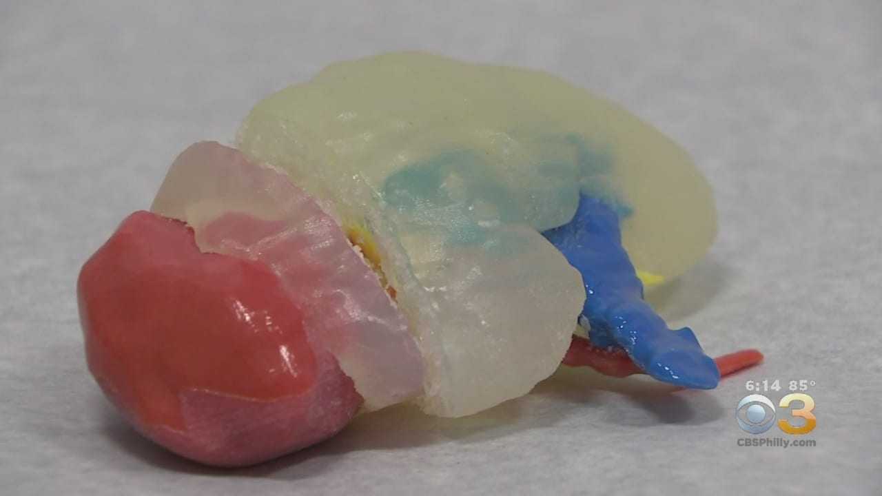 Doctors Use 3D Printer To Replace 5-Year-Old’s Kidney