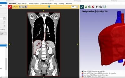 How medical 3D printing helps improve patient outcomes