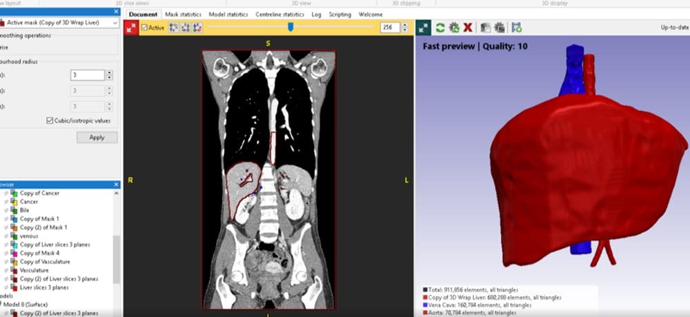 How medical 3D printing helps improve patient outcomes