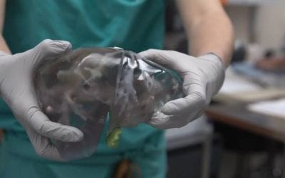 Mom, son make history with live liver donation assisted by 3D printing