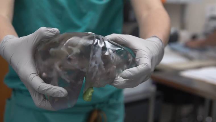 Mom, son make history with live liver donation assisted by 3D printing