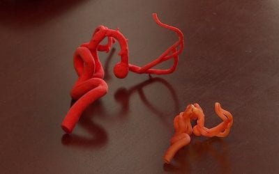 Cleveland Clinic doctors use 3D technology to help with surgical repair of brain aneurysms