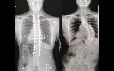 Health Watch: 3D Printing Helps Surgeons Fix Scoliosis