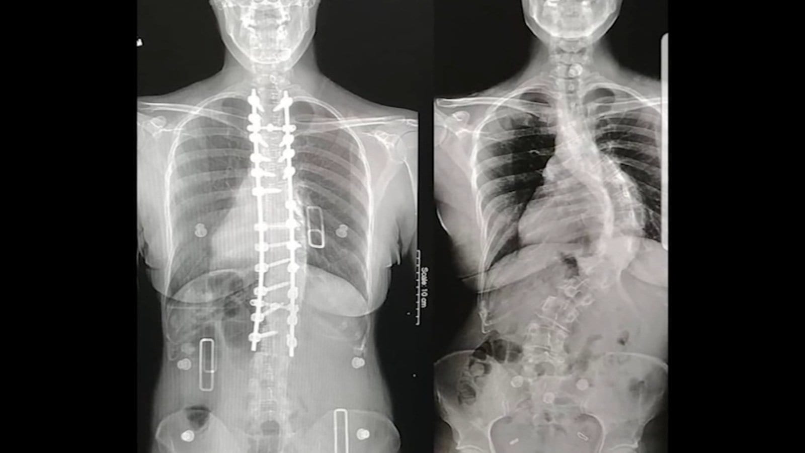 Health Watch: 3D Printing Helps Surgeons Fix Scoliosis