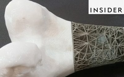 3D Printed Implants Could Help Patients with Bone Cancer