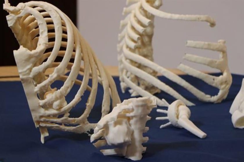 Use of 3D printing grows rapidly among orthopedic surgeons