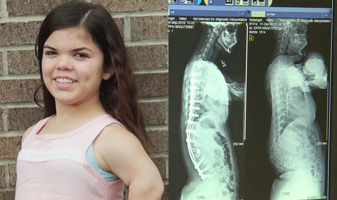 3D printing technology saves Indiana girl from paralysis