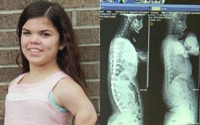 3D printing technology saves Indiana girl from paralysis