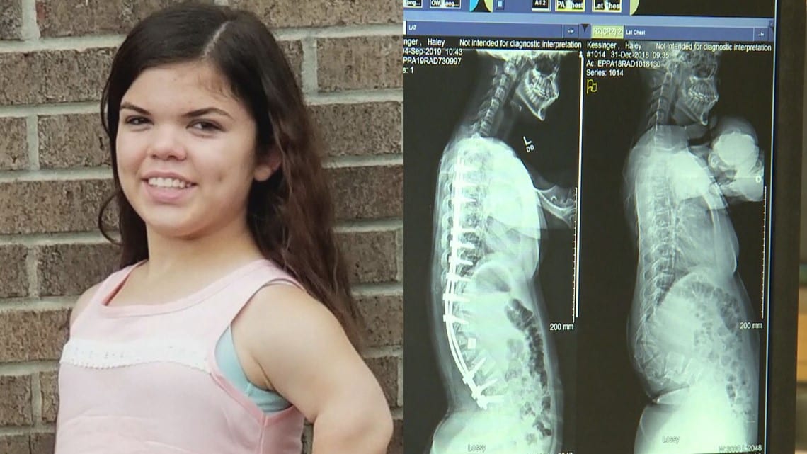 3D printing technology saves Indiana girl from paralysis