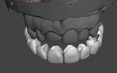 Digitally Creating Snap on Teeth that can be 3d Printed