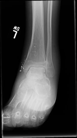 A Closer Look At A Total Talar Replacement And Ankle Arthroplasty