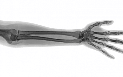 The Development of 3D Printed Custom-Made Bones