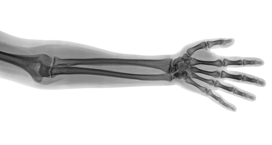 The Development of 3D Printed Custom-Made Bones