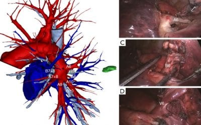 China: Establishing Validity of 3D Printing in Pre-Planning for Early-Stage Lung Cancer Procedures