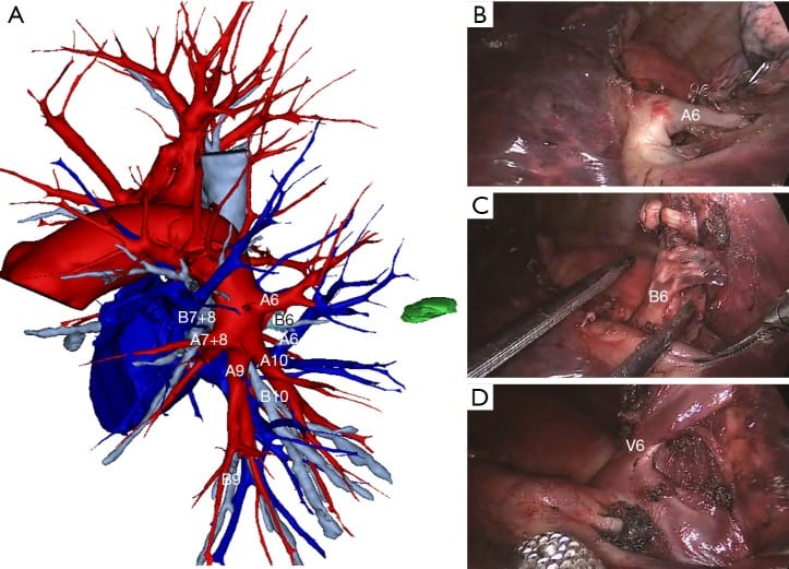 China: Establishing Validity of 3D Printing in Pre-Planning for Early-Stage Lung Cancer Procedures