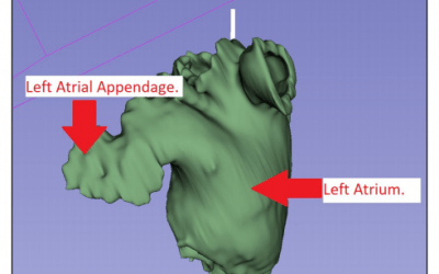 3D Printing the Left Atrial Appendage for Better Closure Procedures in Surgery