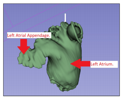 3D Printing the Left Atrial Appendage for Better Closure Procedures in Surgery