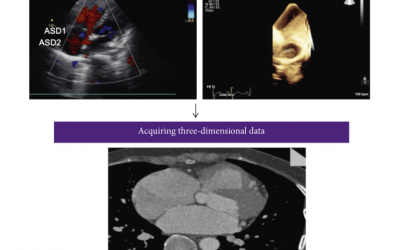 Researchers Evaluate Feasibility of Closing Multiple Atrial Septal Defects Guided by 3D Printed Model