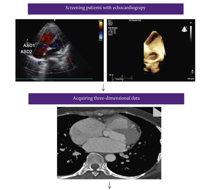 Researchers Evaluate Feasibility of Closing Multiple Atrial Septal Defects Guided by 3D Printed Model