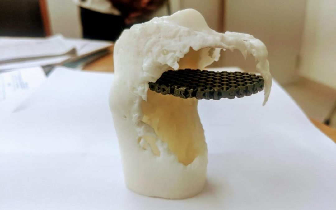 18-year-old girl becomes first to get 3D-printed shinbone in Karnataka