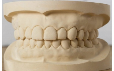 Prosthetic Dental Treatments: Traditional Stone Casts vs. 3D Printed Casts