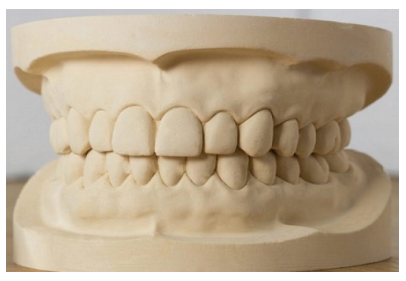 Prosthetic Dental Treatments: Traditional Stone Casts vs. 3D Printed Casts