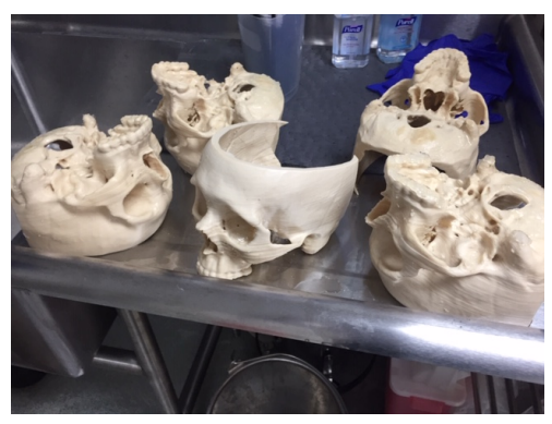 3D Printed FibreTuff Medical Models Are Bone-Like & Anatomically Correct