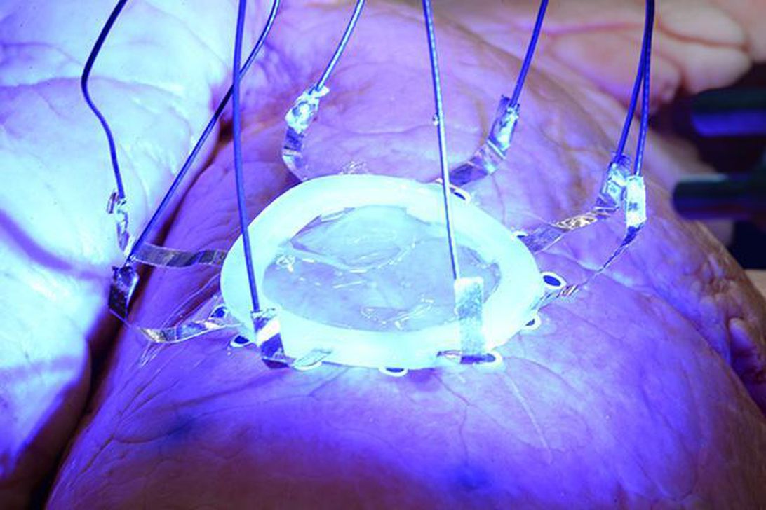 See how researchers 3D-print a soft medical sensor on an expanding lung