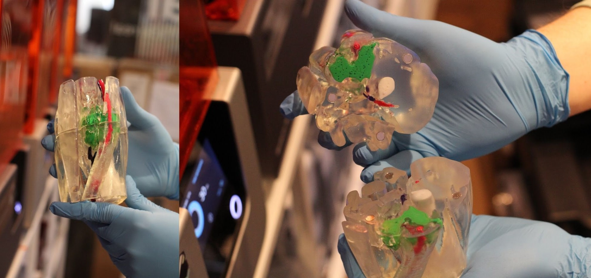 Axial3D Enhances Visualisations of Complex Anatomy with 3D Printing