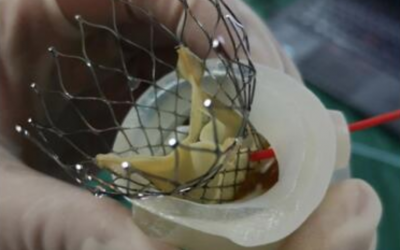 3D Printing for Preoperative Simulation of Complex Cardiovascular Surgery