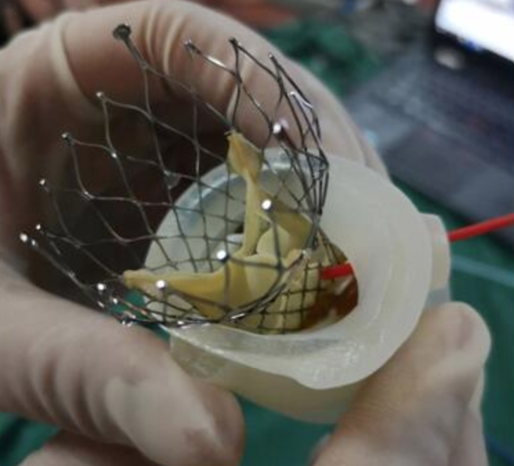 3D Printing for Preoperative Simulation of Complex Cardiovascular Surgery