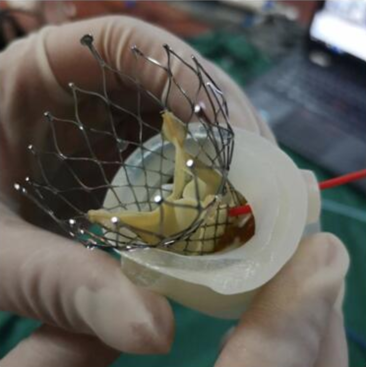 3D Printing for Preoperative Simulation of Complex Cardiovascular Surgery