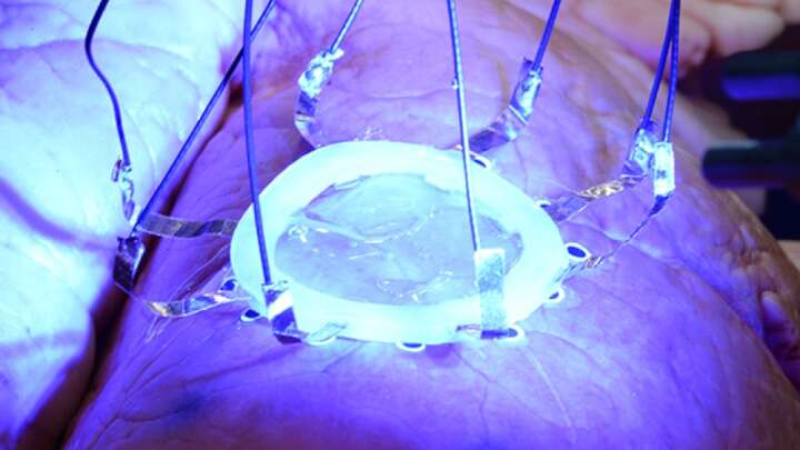 Medical Engineers 3D Print Sensors Directly Onto A Moving Lung