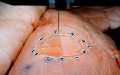 3D Printing Sensors Directly Onto Expanding Organs Is Now Possible