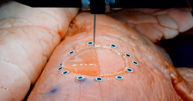 3D Printing Sensors Directly Onto Expanding Organs Is Now Possible