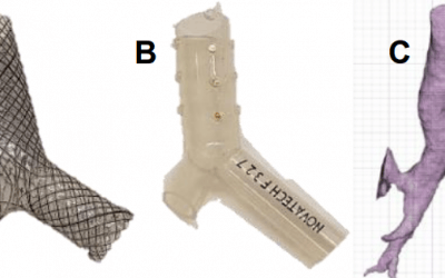 Lung Cancer Treatment: 3D Printing Molds for Personalized Airway Stents