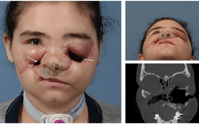 3D Printing and Virtual Surgery Help Repair Damage to Patient’s Face