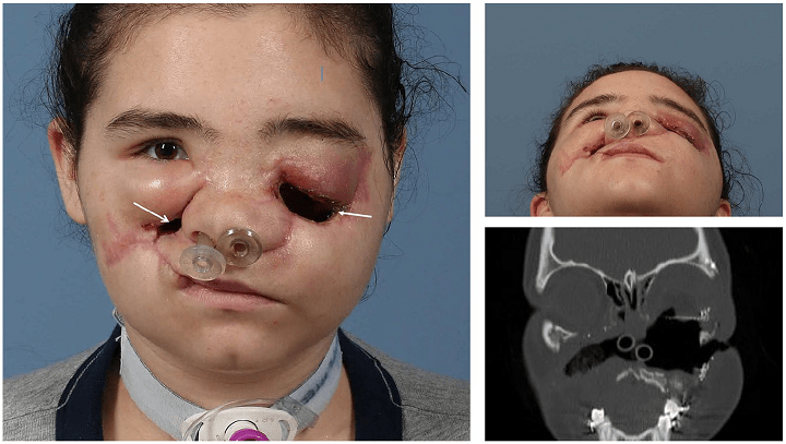 3D Printing and Virtual Surgery Help Repair Damage to Patient’s Face