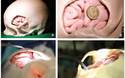 3D Printing Aids Intracranial Aneurysm Microsurgery Simulation