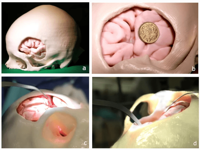 3D Printing Aids Intracranial Aneurysm Microsurgery Simulation